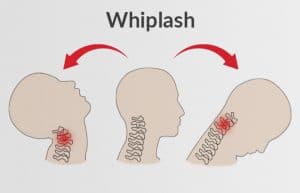 Whiplash Injury Guide