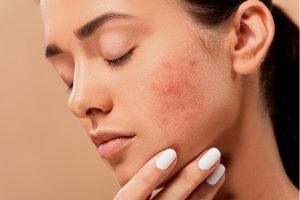 Remedies to Get Rid Of Acne Scars From Your Skin